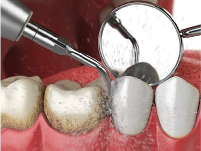 Limpeza dental em Peruíbe — Dra. Camila Meister