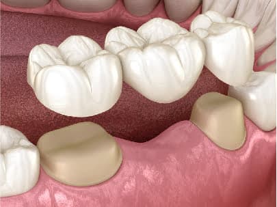 Prótese dentária em Peruíbe — Dra. Camila Meister
